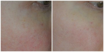 loreal skin perfection
